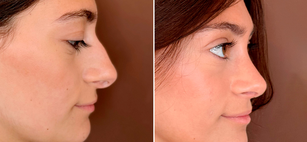 Rinoplastia en buenos aires