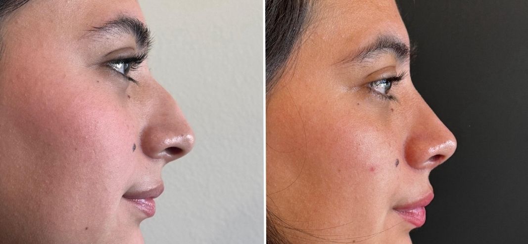 rinoplastia buenos aires