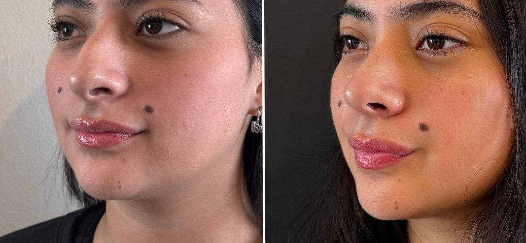 cirujano de rinoplastia