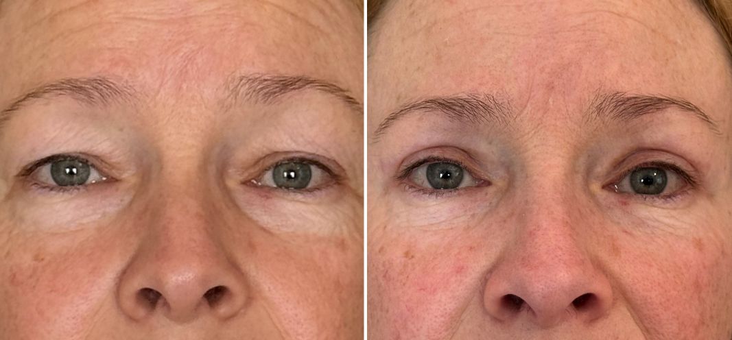 cirugía de parpados - blefaroplastia