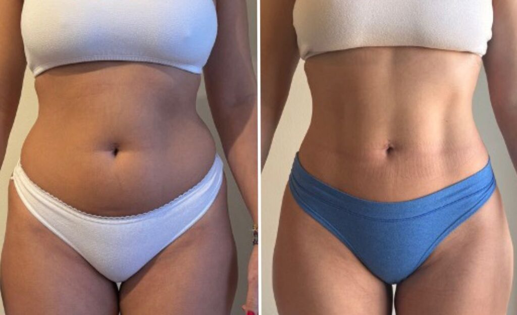 Resultados de la liposucción con Renuvion: tiempos, cambios y expectativas reales