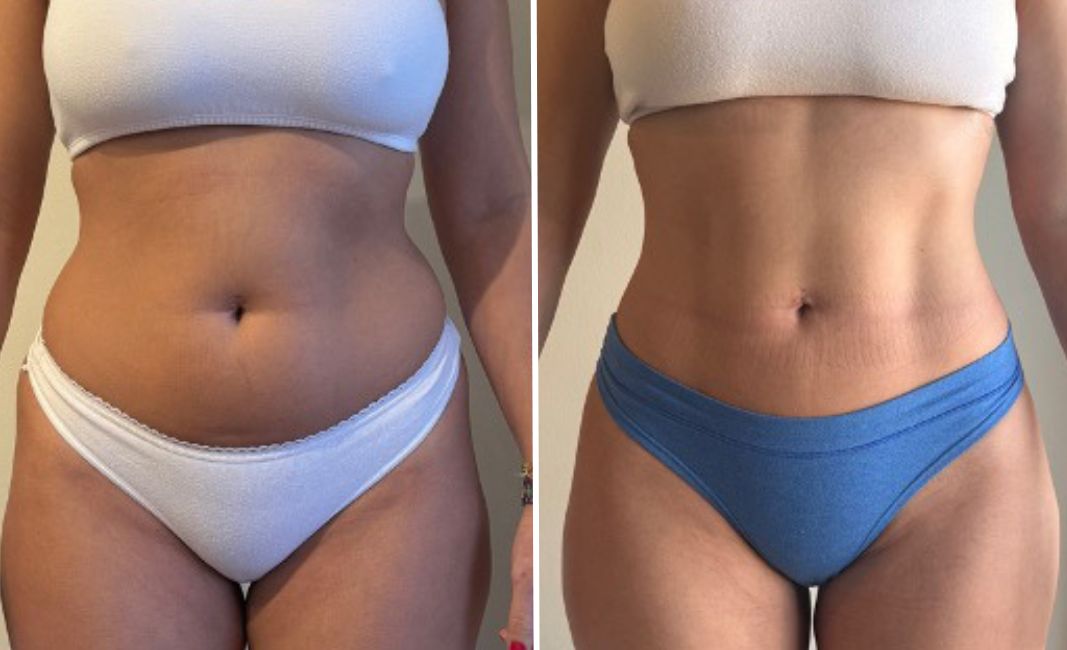 Resultados de la liposucción con Renuvion