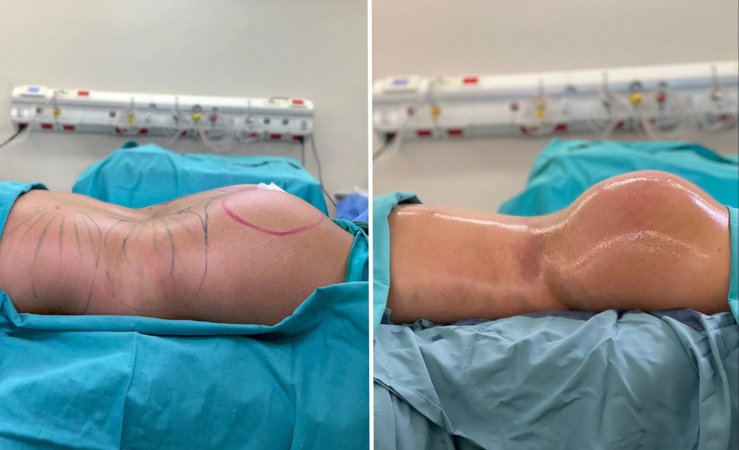lipotransferencia glútea en buenos aires