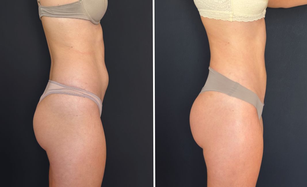 29jul-WEB-lipotransferencia-glutea