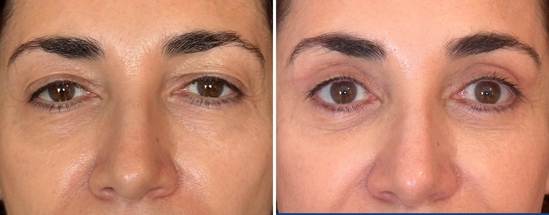Blefaroplastia-2025