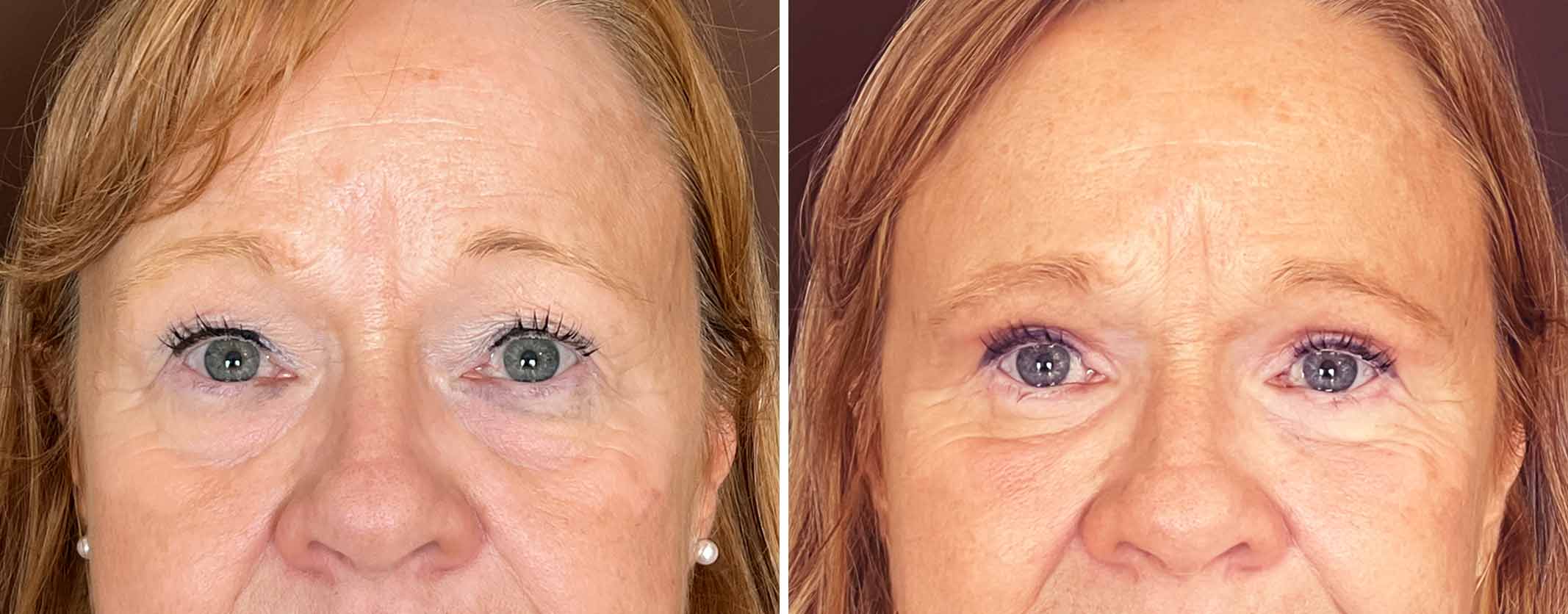 Blefaroplastia-blanch-cicatriz