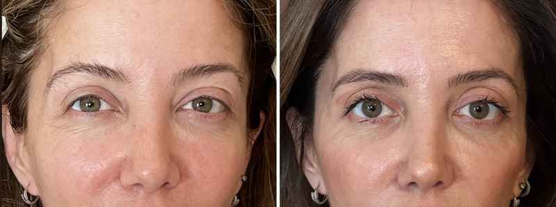 Blefaroplastia-bootello