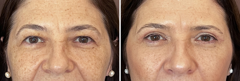 Blefaroplastia-ketzelman