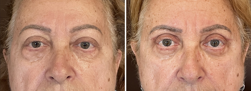 Blefaroplastia-minutella