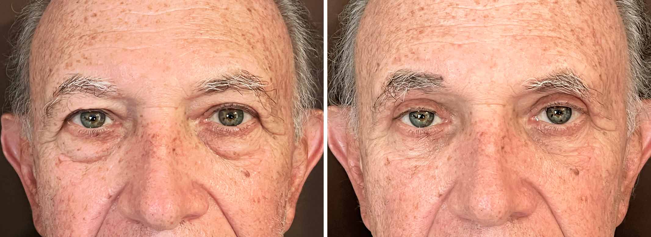 Blefaroplastia-vaisman-color