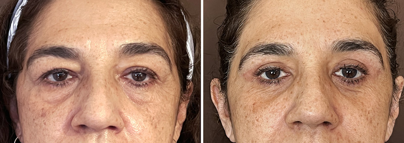 Blefaroplastia-viola