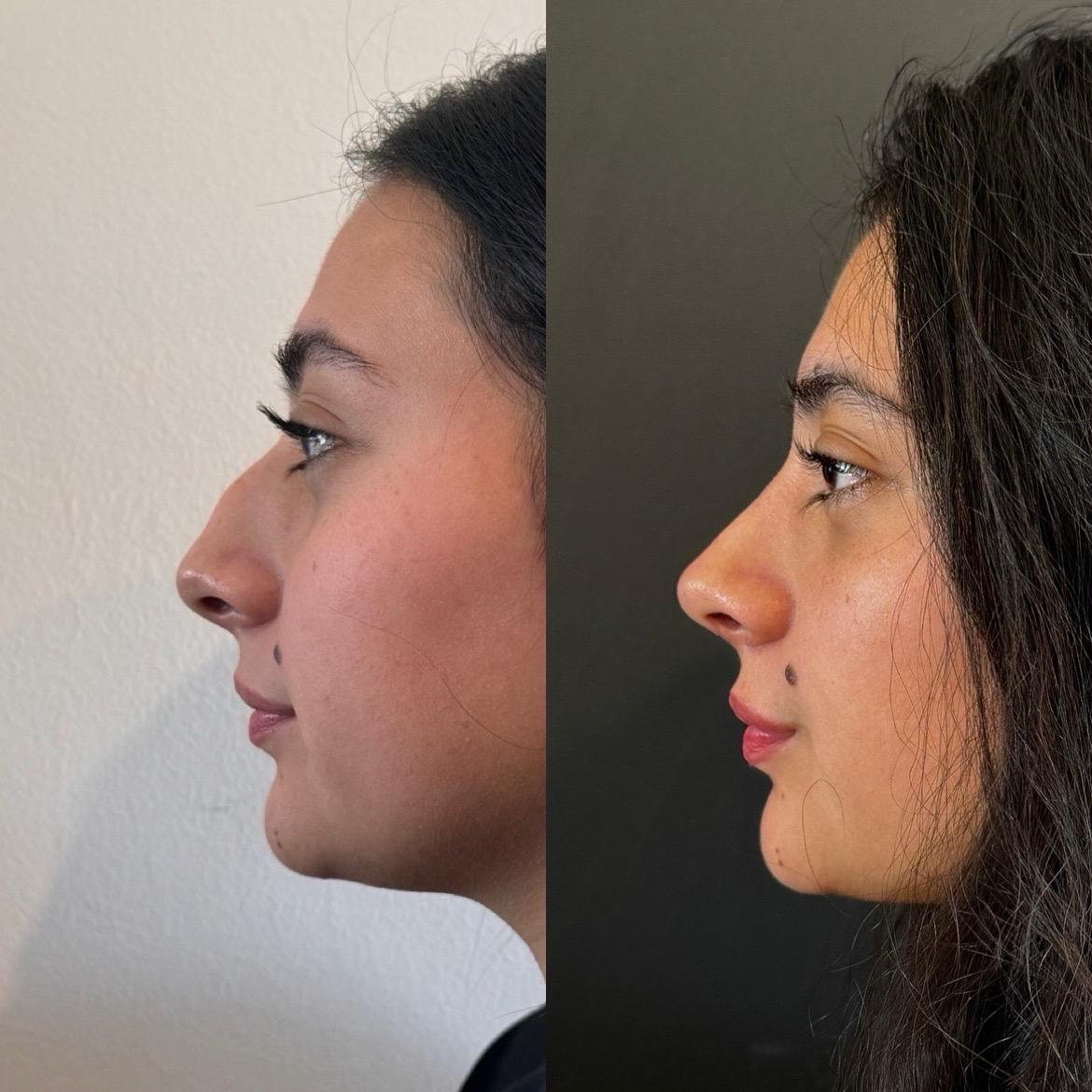 rinoplastia buenos aires