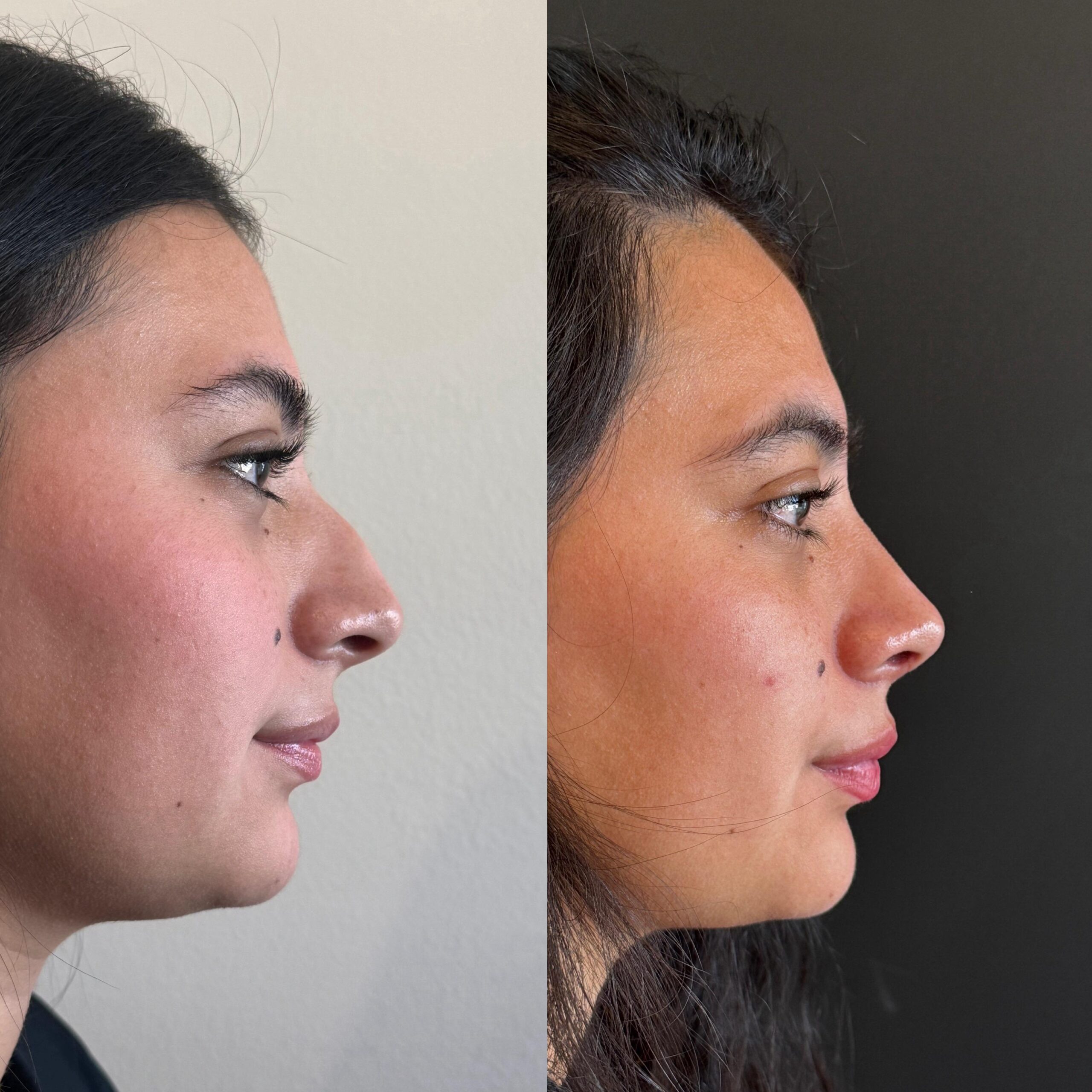 rinoplastia buenos aires