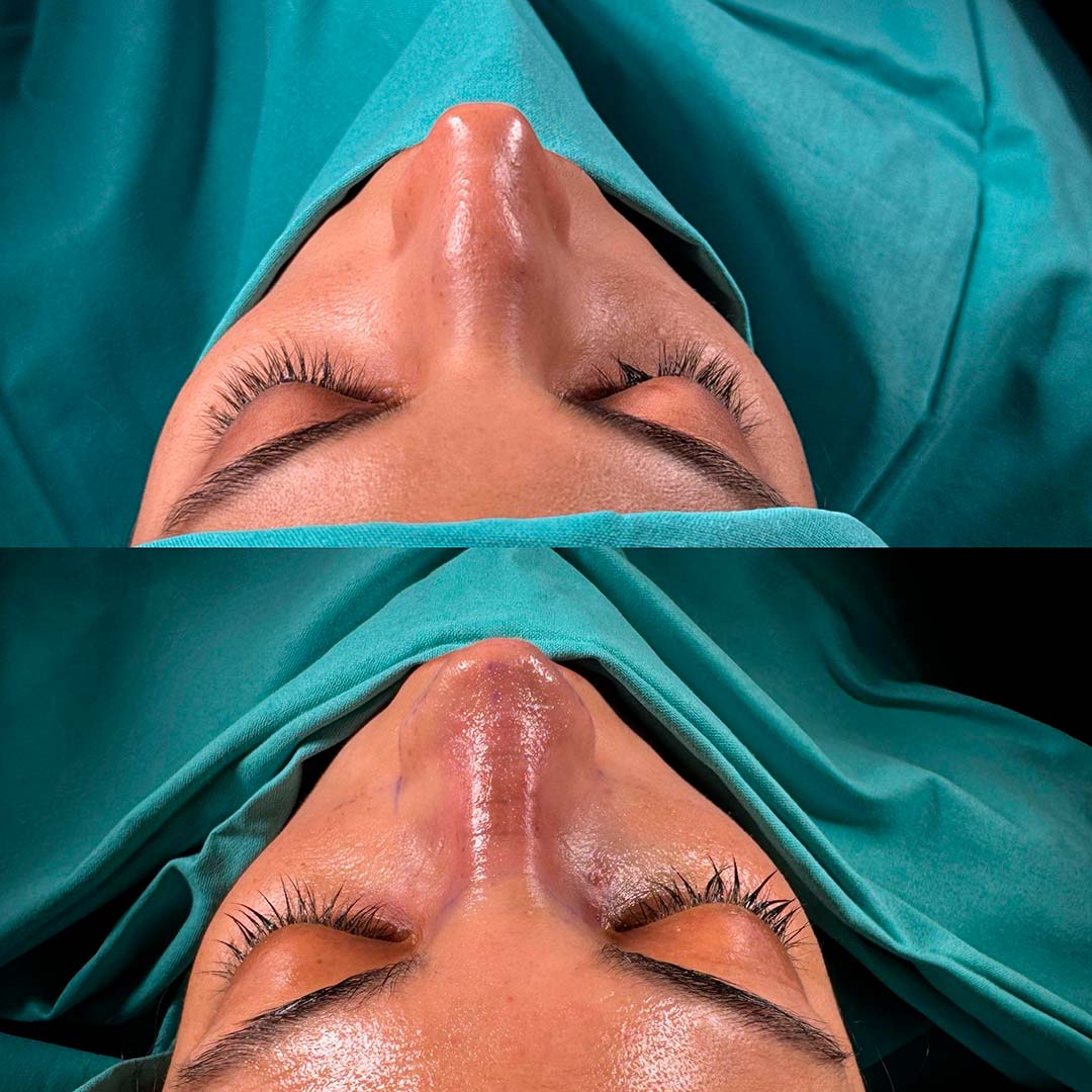 rinoplastia buenos aires