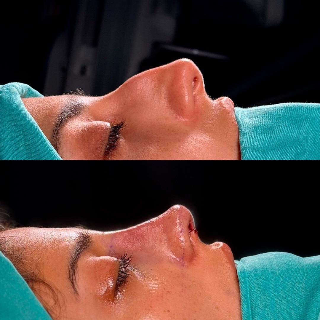rinoplastia buenos aires