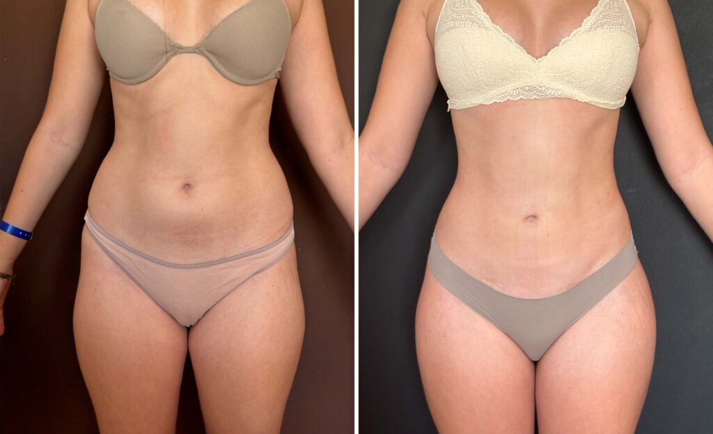 Liposucción de alta definición con Renuvion