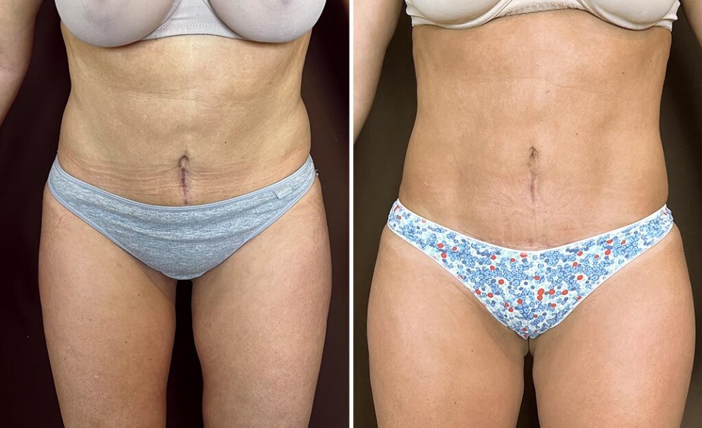 ventajas de la liposucción con Renuvion