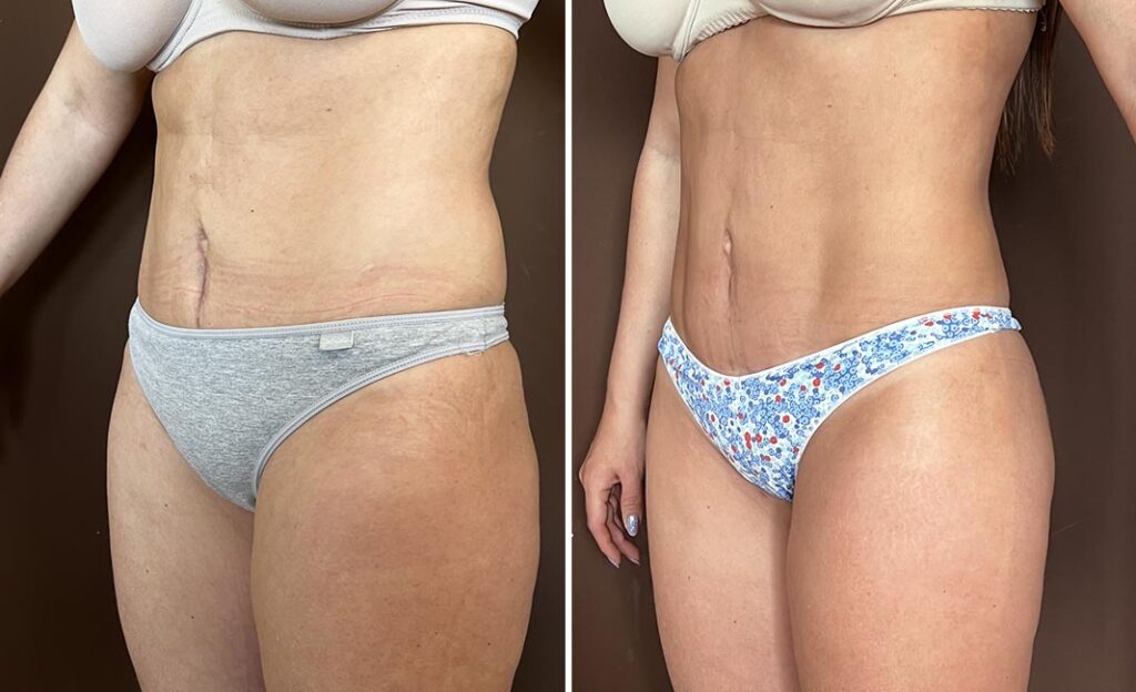 Ventajas de la liposucción con Renuvion y en qué partes del cuerpo se puede aplicar