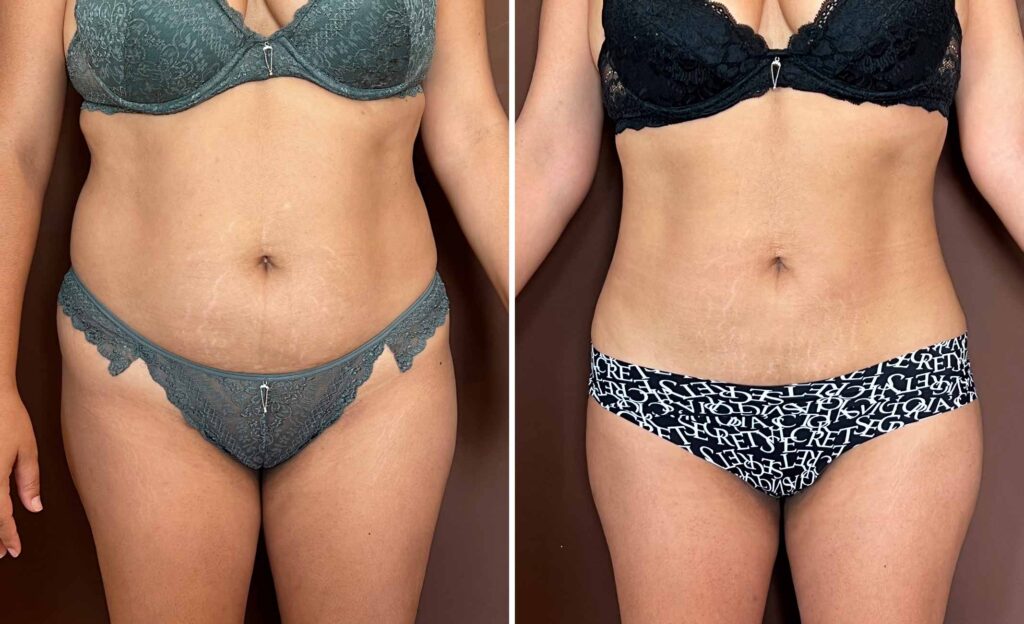 Liposucción de alta definición con Renuvion