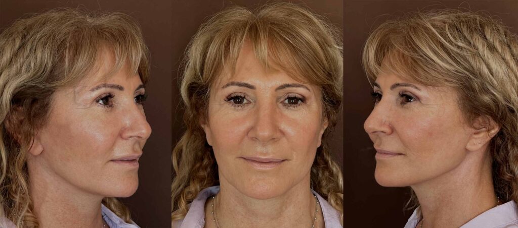 lifting facial en buenos aires